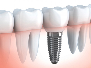 impianti dentali impianti dentali