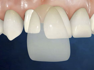 facette estetiche facette estetiche