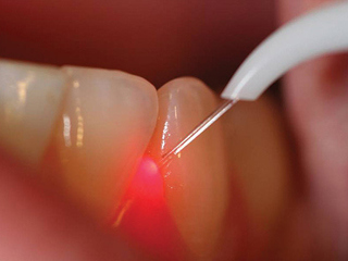 laser terapia laser terapia