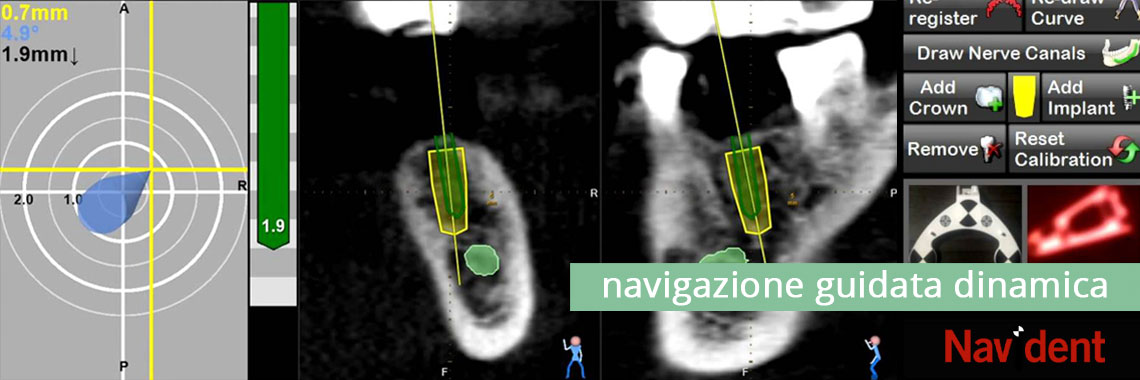 navident chirurgia implantare navident chirurgia implantare